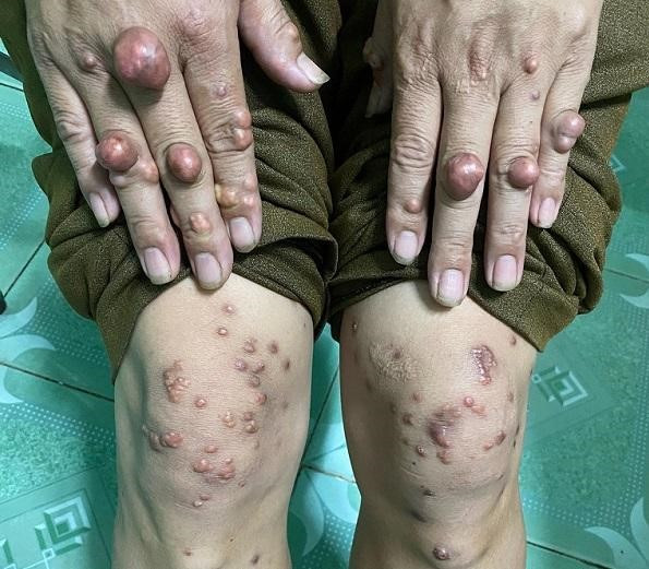 Bệnh nhân rối loạn mỡ máu bị nổi u cục ở tay và chân.