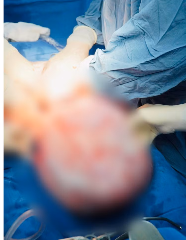 Khối u khủng được lấy ra