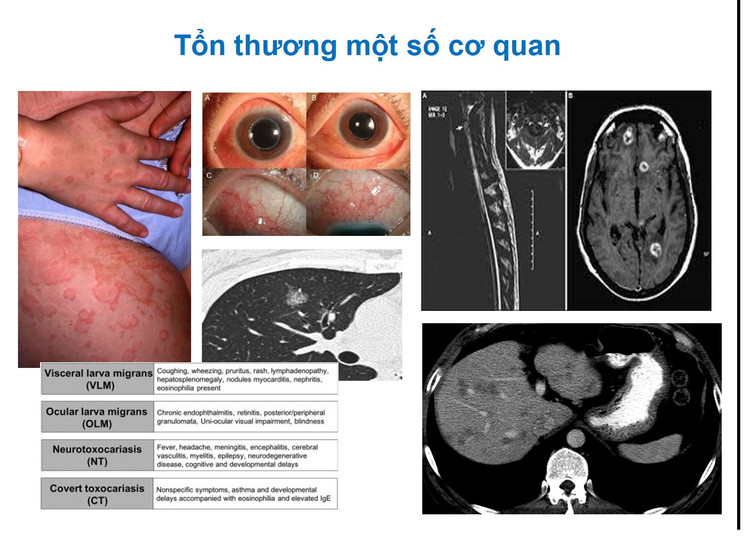 Giun đũa chó gây tổn thương 1 số cơ quan