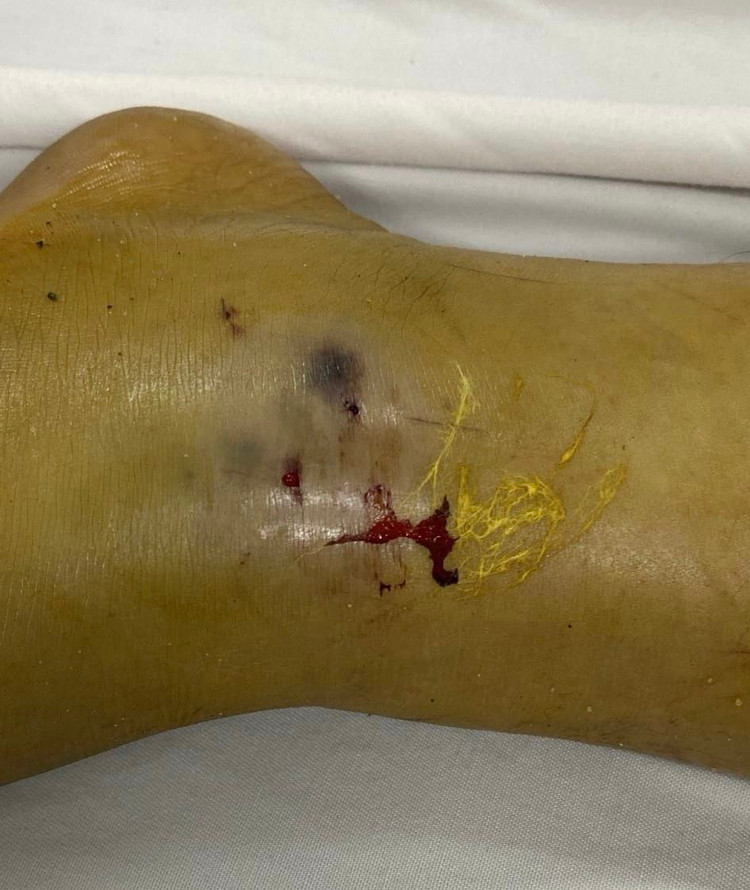 Vết bọ cạp cắn ở trẻ - Ảnh BVCC