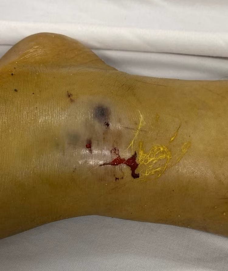 Vết bọ cạp cắn ở trẻ - Ảnh BVCC