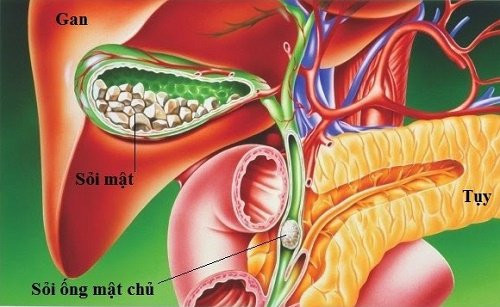 Sỏi túi mật - Ảnh minh họa