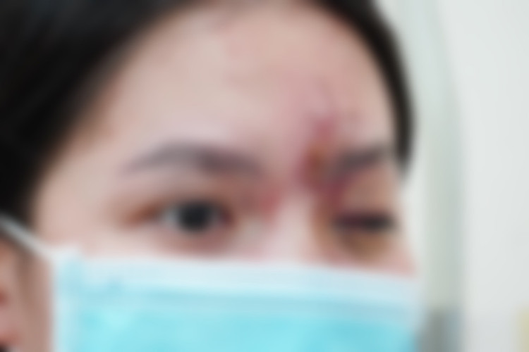 Cô gái trẻ 17 tuổi mù mắt vì tiêm filler ở tiệm cắt tóc, gội đầu ảnh 1