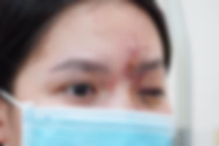 Cô gái trẻ 17 tuổi mù mắt vì tiêm filler ở tiệm cắt tóc, gội đầu ảnh 1