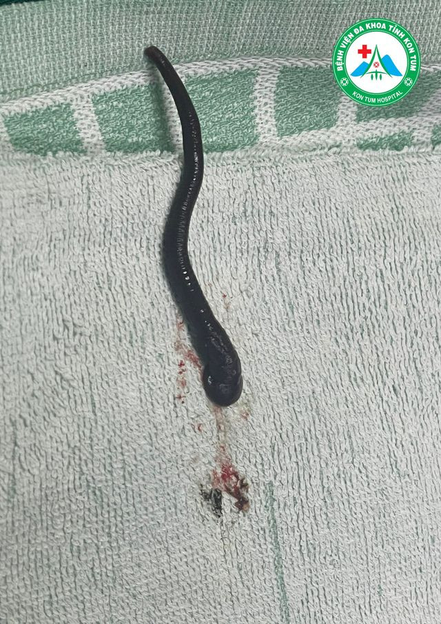 Con vắt được lấy ra khỏi mũi bệnh nhân