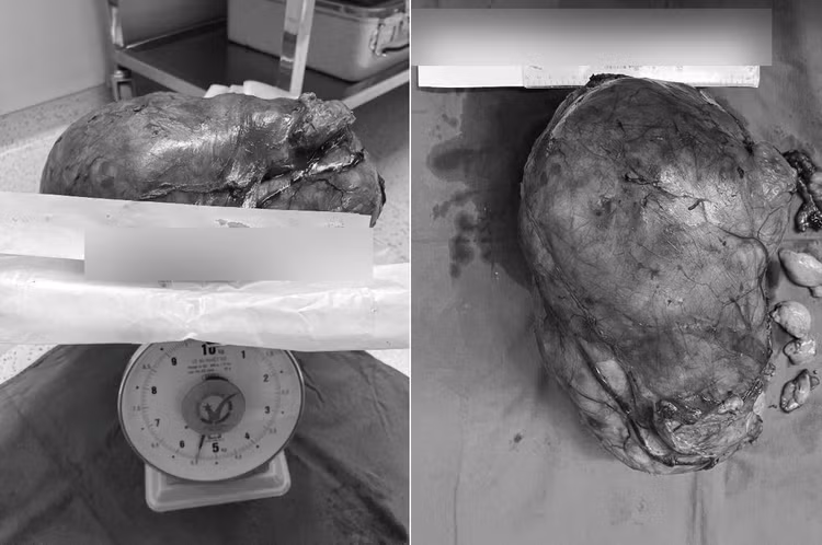 Hình ảnh khối u được lấy ra khỏi bụng bệnh nhân