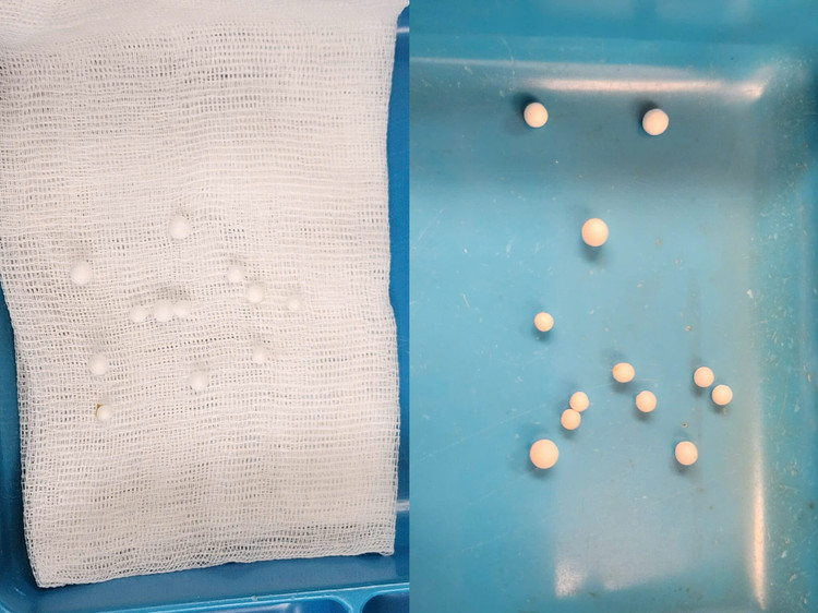 12 dị vật được lấy ra trong mũi của trẻ - Ảnh BVCC