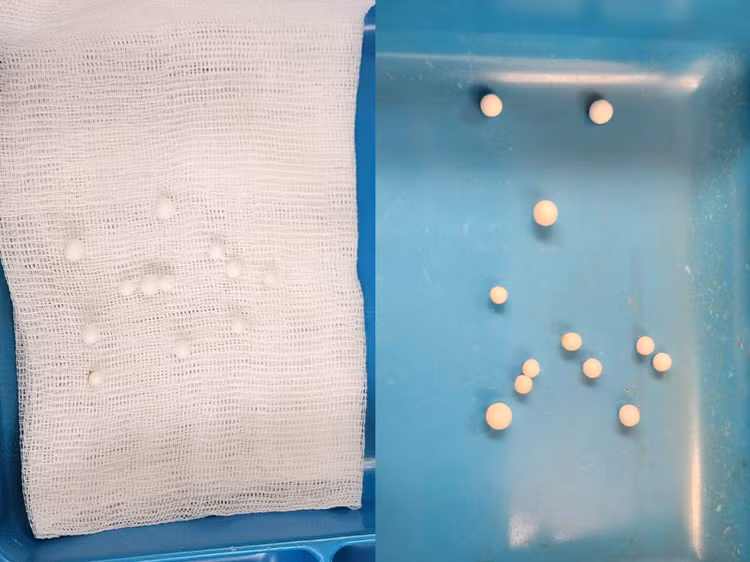 12 dị vật được lấy ra trong mũi của trẻ - Ảnh BVCC