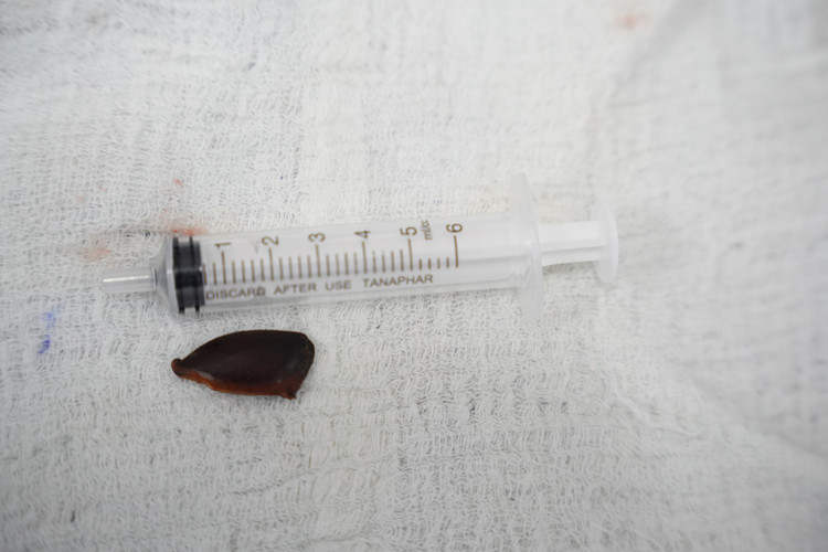 Hạt hồng xiêm được gắp ra - Ảnh BVCC