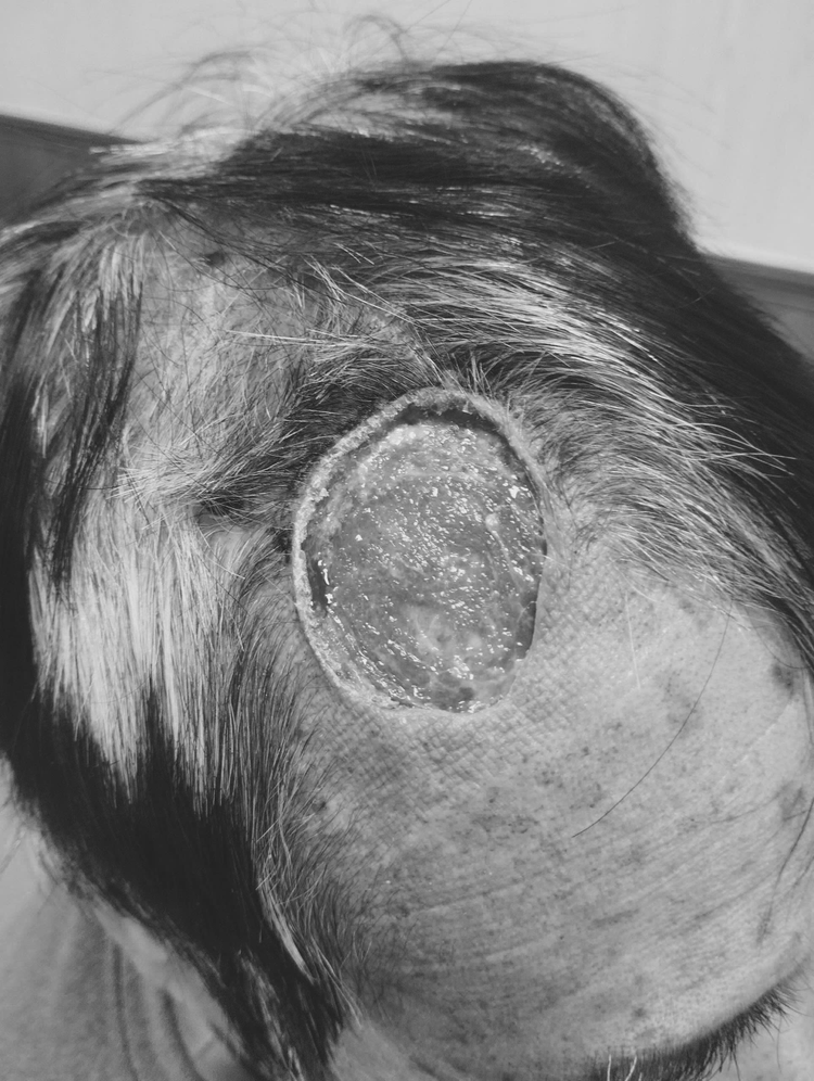 Hình ảnh khuyết hổng vùng trán của người bệnh - Ảnh BVCC