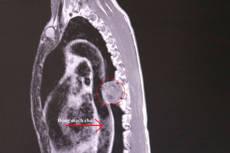 Khối u trung thất lớn chèn ép tủy trên phim chụp - Ảnh BVCC
