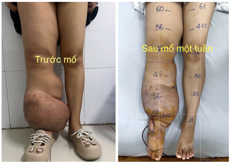 Hình ảnh phù bạch mạch trước và sau mổ - Ảnh BVCC