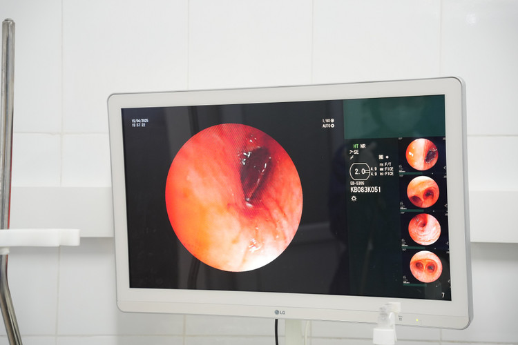 Nội soi phát hiện hạt hồng xiêm trong phế quản bệnh nhân - Ảnh BVCC