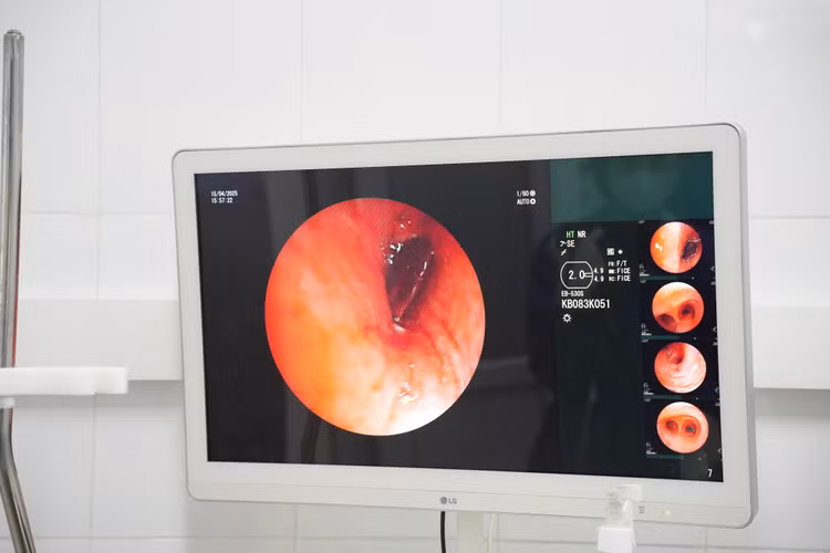 Nội soi phát hiện hạt hồng xiêm trong phế quản bệnh nhân - Ảnh BVCC