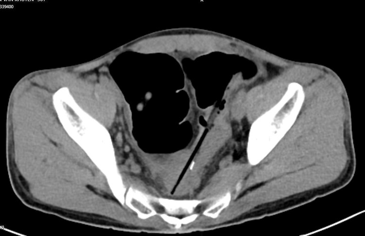 Bệnh nhân được chẩn đoán: Áp xe trong ổ bụng do thủng đại tràng sigma do dị vật, dị vật ruột non/tâm thần phân liệt.