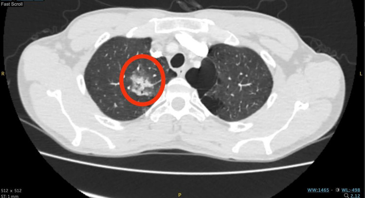 Hình ảnh CT vùng tổn thương trước can thiệp - Ảnh BVCC