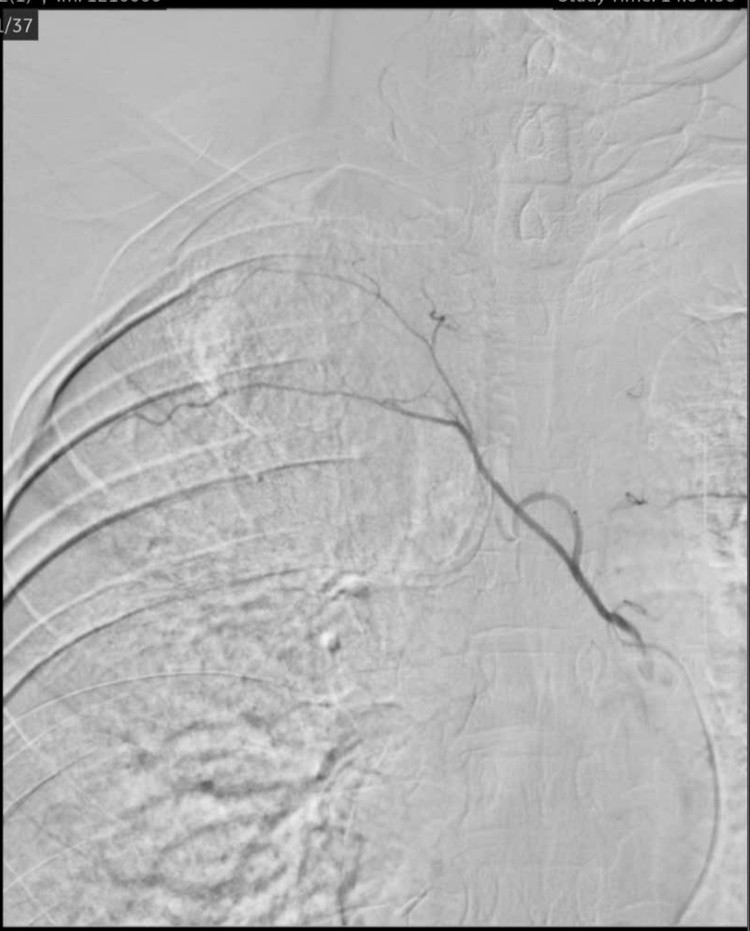 Hình ảnh sau can thiệp mạch - Ảnh BVCC