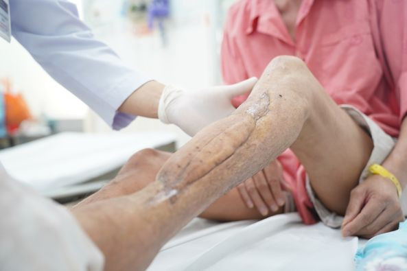 Mảnh ghép cá thể che phủ tổn thương cho bệnh nhân - Ảnh BVCC