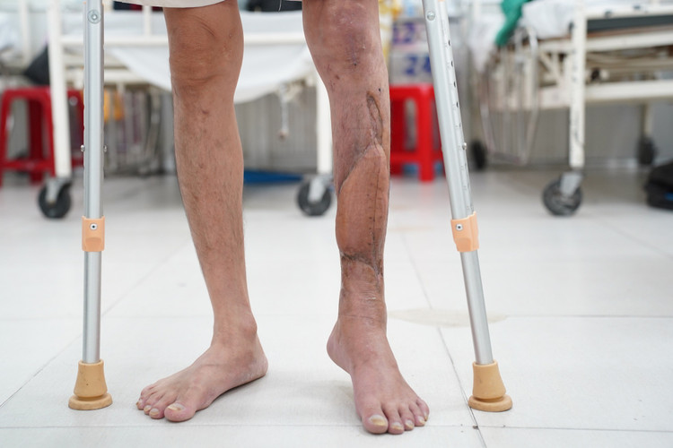 Bệnh nhân tập đi lại - ảnh BVCC