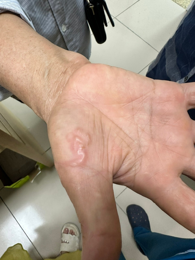 Giun bò nổi trên tay người bệnh - Ảnh BVCC