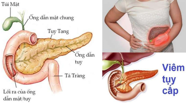 Nhiều người bị viêm tụy cấp - Ảnh minh họa