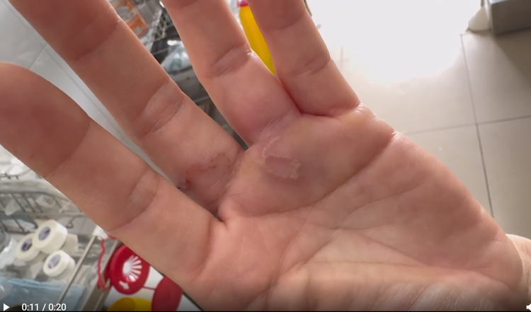 Ấu trùng giun đũa chó mèo nổi trên tay bệnh nhân.