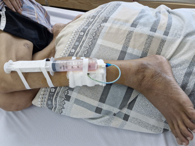 Bệnh nhân nhiễm bệnh whitmore bị áp xe cẳng chân - Ảnh BVCC