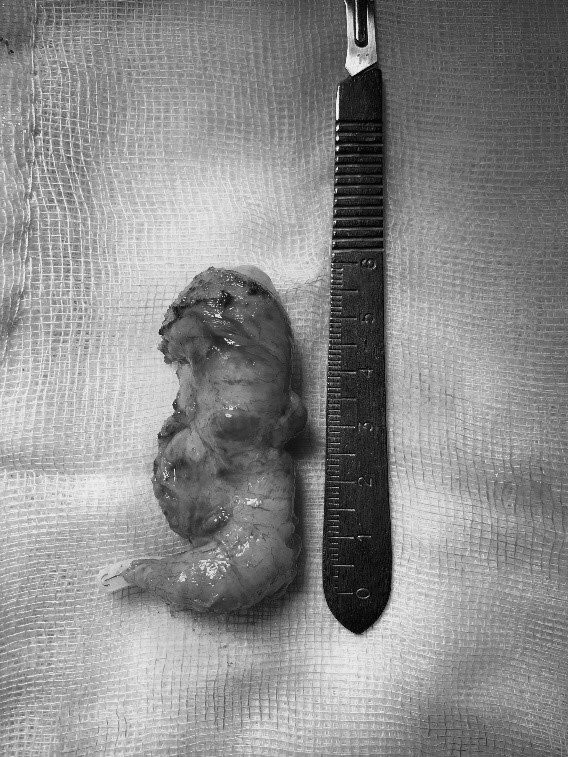 Khối u nhầy ruột thừa được lấy bỏ