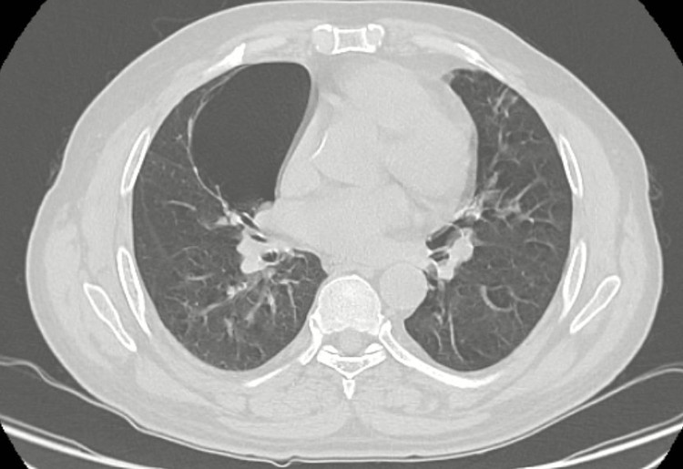 Kén khí phổi trên phim chụp của bệnh nhân