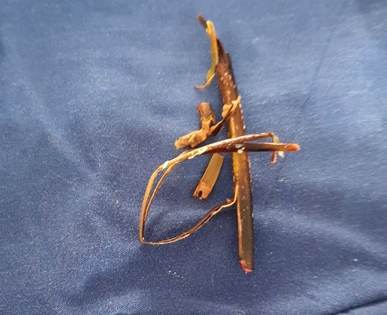 Cành cây khô trong bàng quang bệnh nhân được lấy ra - ảnh BVCC