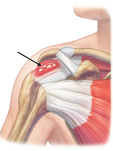 Đau vai nhiều về đêm do viêm gân vôi hóa