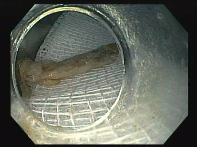 Xương gà dài 2,5 cm được lấy ra