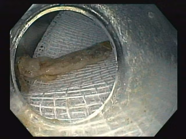 Xương gà dài 2,5 cm được lấy ra