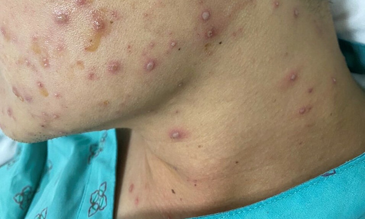 Khi có bệnh thủy đậu nên đi khám để tránh biến chứng đáng tiếc