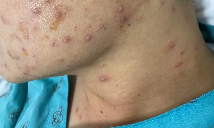 Khi có bệnh thủy đậu nên đi khám để tránh biến chứng đáng tiếc