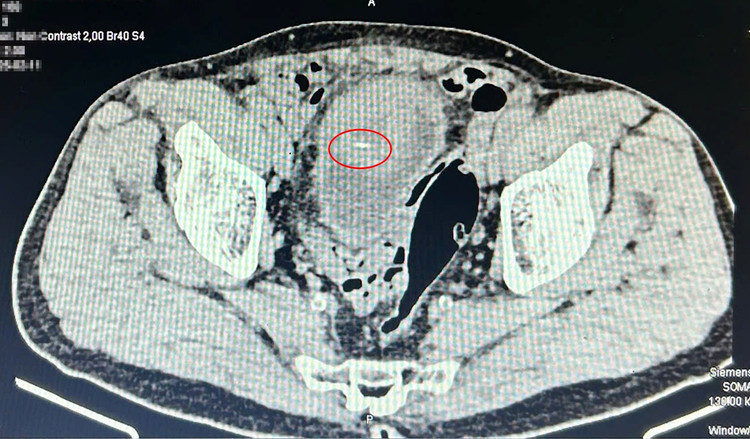 Hình ảnh chụp cắt lớp dị vật nhọn trong bàng quang của bệnh nhân C - Ảnh BVCC