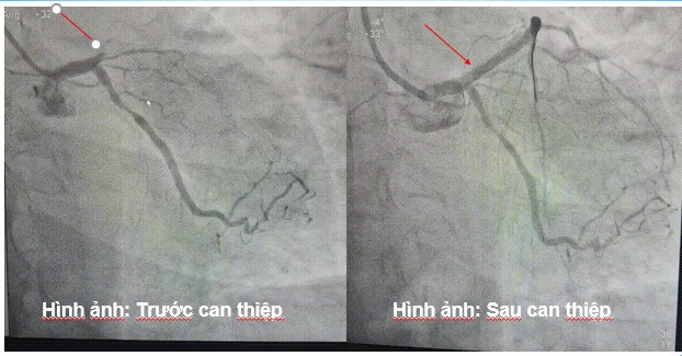 Kết quả trước và sau can thiệp - Ảnh BVCC