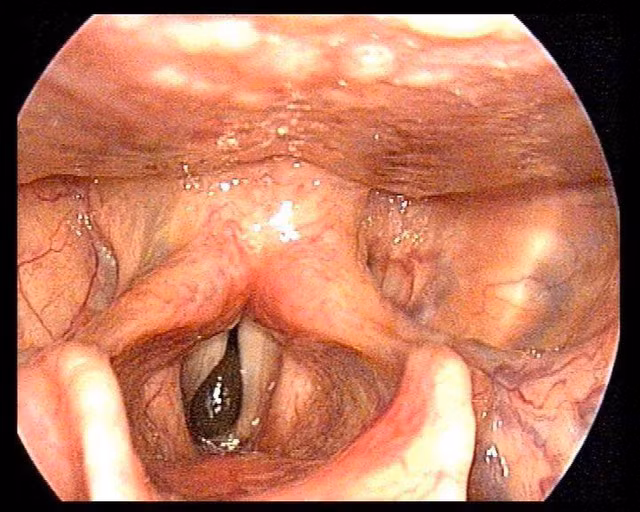 Hình ảnh con đỉa sống trong cổ họng người bệnh.