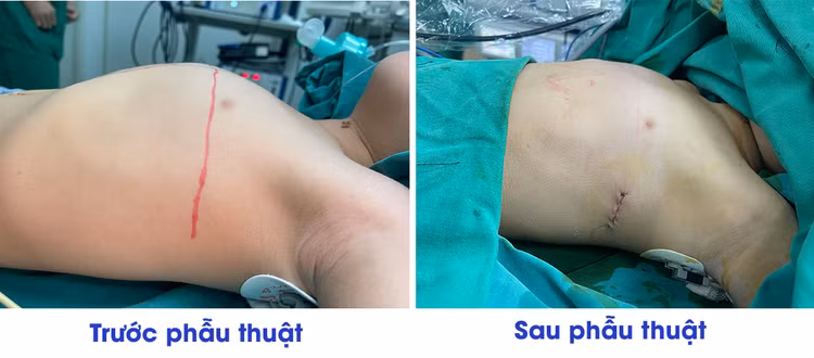 Chỉnh xương ức lồi như ức gà cho trẻ 3 tuổi ảnh 1