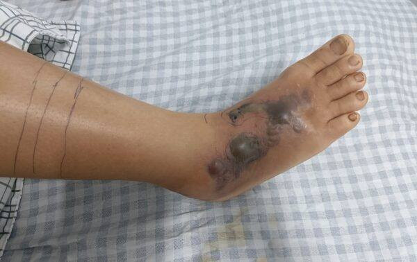 Hoại tử mu bàn chân phải vì rắn cắn