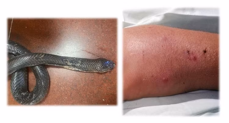 Truyền 70 lọ huyết thanh “cứu” liên tiếp 03 bệnh nhân bị rắn cắn tại nhà