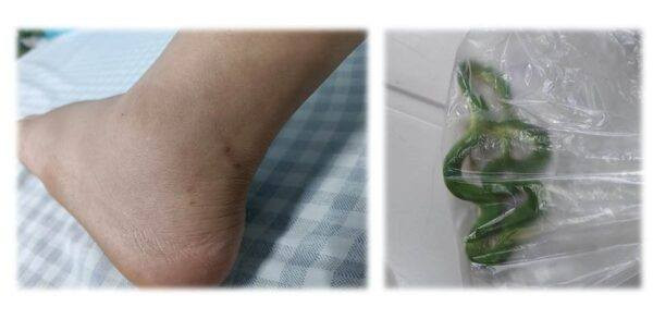 Bệnh nhân bị rắn lục cắn tại nhà