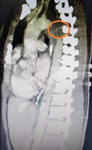 Hình ảnh CT scaner ngực phát hiện xương cá được khoanh tròn đỏ