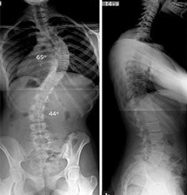 Hình ảnh X-Quang vẹo cột sống