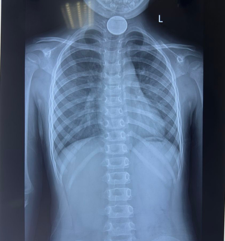 Bé 4 tuổi bị dị vật đồng xu nằm giữa thực quản