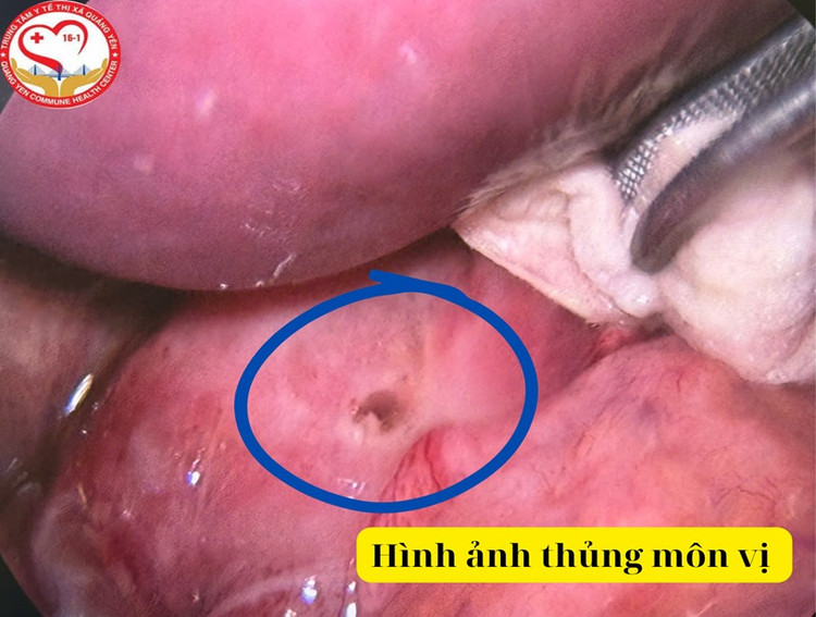 Hình ảnh thủng môn vị dạ dày - Ảnh BVCC