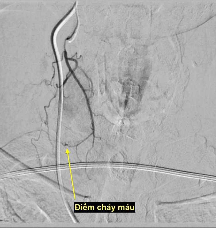 Điểm chảy máu sau chọc tế bào tuyến giáp - Ảnh BSCC