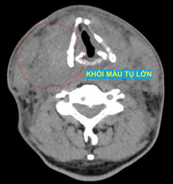 Khối máu tụ lớn sau chọc tế bào tuyến giáp - Ảnh BSCC