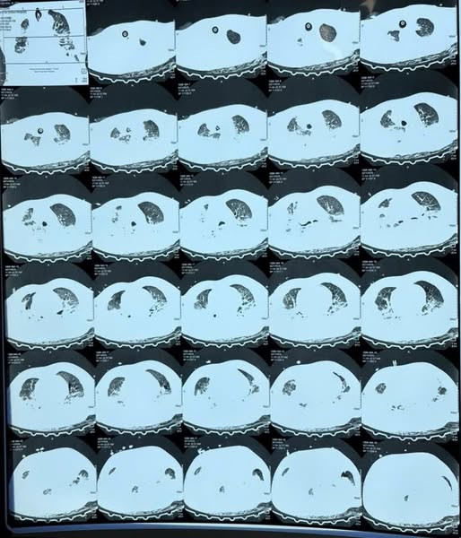 Tổn thương phổi của bệnh nhân trên phim chụp - Ảnh minh họa