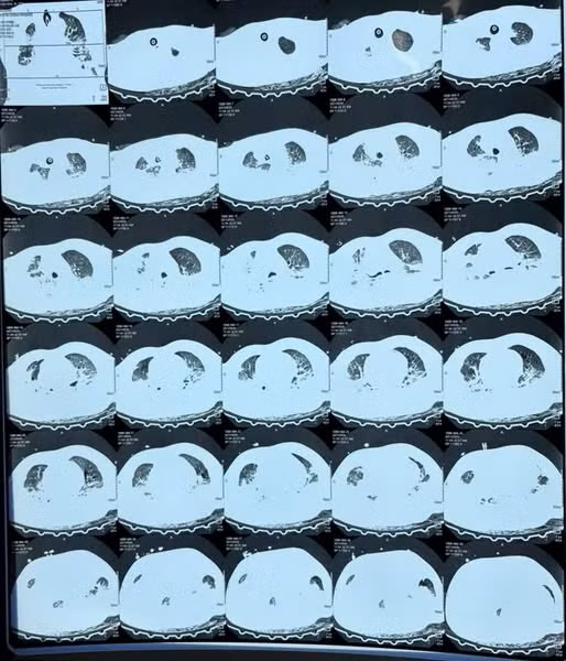 Tổn thương phổi của bệnh nhân trên phim chụp - Ảnh minh họa